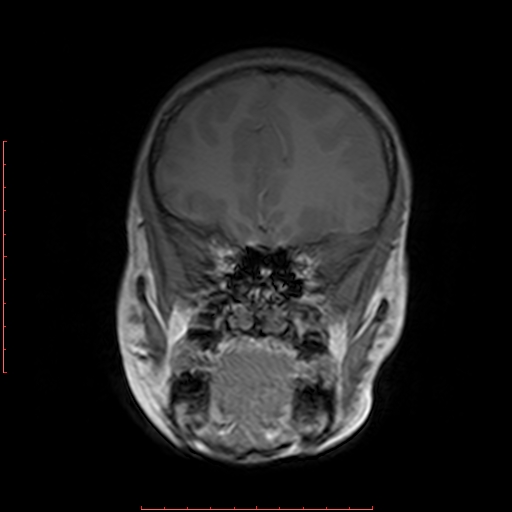 File:Astroblastoma (Radiopaedia 74287-85162 Coronal T1 5).jpg