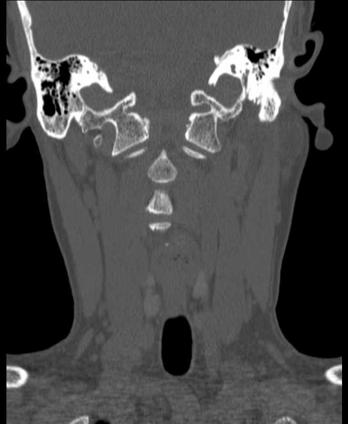 Atlanto-occipital assimilation with basilar invagination (Radiopaedia 70122-80188 Coronal bone window 66).jpg