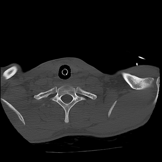 File:Atlanto-occipital dissociation (Traynelis type 1), C2 teardrop fracture, C6-7 facet joint dislocation (Radiopaedia 87655-104061 Axial bone window 84).jpg