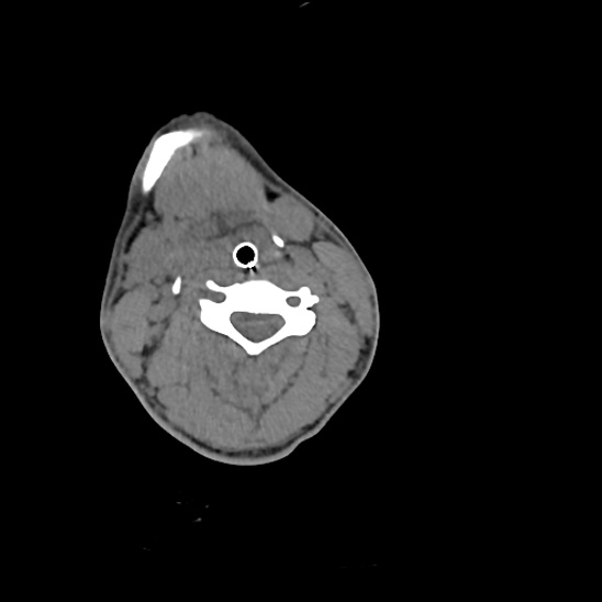 File:Atlanto-occipital dissociation (Traynelis type 1), C2 teardrop fracture, C6-7 facet joint dislocation (Radiopaedia 87655-104061 Axial non-contrast 42).jpg
