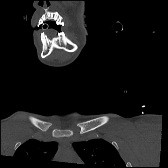 Atlanto-occipital dissociation (Traynelis type 1), C2 teardrop fracture, C6-7 facet joint dislocation (Radiopaedia 87655-104061 Coronal bone window 7).jpg