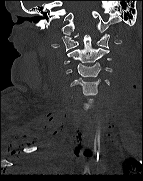 Atlanto-occipital dissociation - Traynelis type 1 (Radiopaedia 87570-103948 Coronal bone window 29).jpg