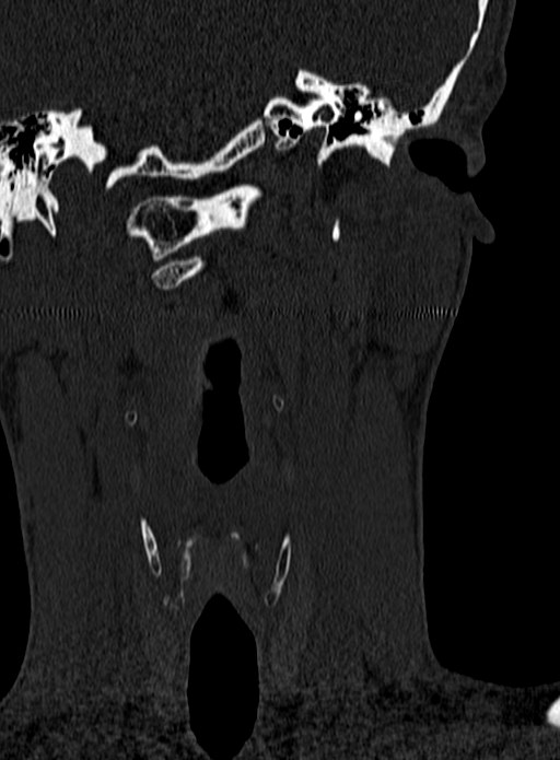 Atlantoaxial subluxation (Radiopaedia 44681-48450 Coronal bone window 2).jpg
