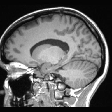 File:Atretic encephalocoele with inferior vermis hypoplasia (Radiopaedia 30443-31108 Sagittal T1 52).jpg