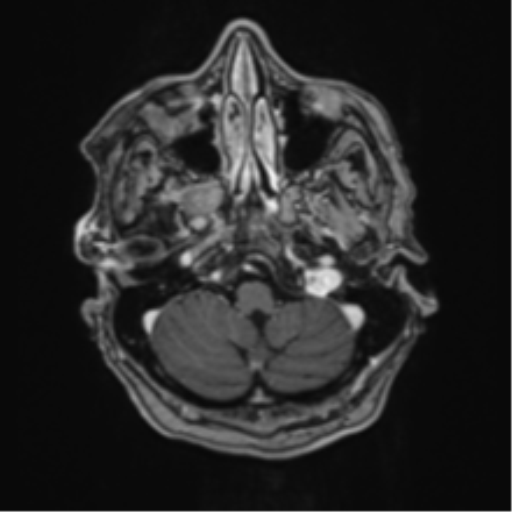 Atypical meningioma (WHO Grade II) (Radiopaedia 54742-60981 Axial T1 C+ 11).png