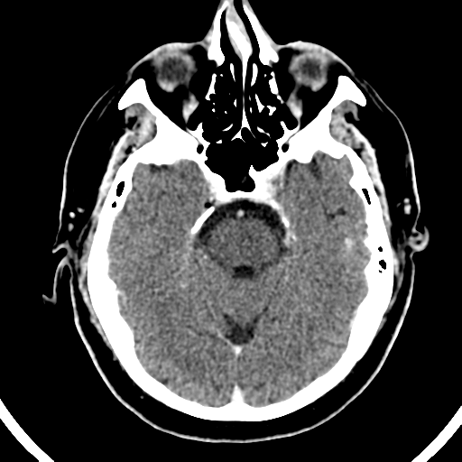 File:Atypical meningioma (WHO grade II) with brain invasion (Radiopaedia 57767-64728 Axial C+ 39).png