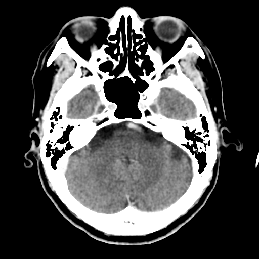 Atypical meningioma with skull invasion (Radiopaedia 34357-35649 Axial C+ delayed 15).png