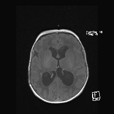 File:Atypical teratoid rhabdoid tumor (prenatal US and neonatal MRI) (Radiopaedia 59091-66388 Axial T1 33).jpg