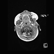 Atypical teratoid rhabdoid tumor (prenatal US and neonatal MRI) (Radiopaedia 59091-66388 Axial T1 C+ 7).jpg