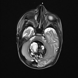File:Atypical teratoid rhabdoid tumor (prenatal US and neonatal MRI) (Radiopaedia 59091-66388 Axial T2 10).jpg