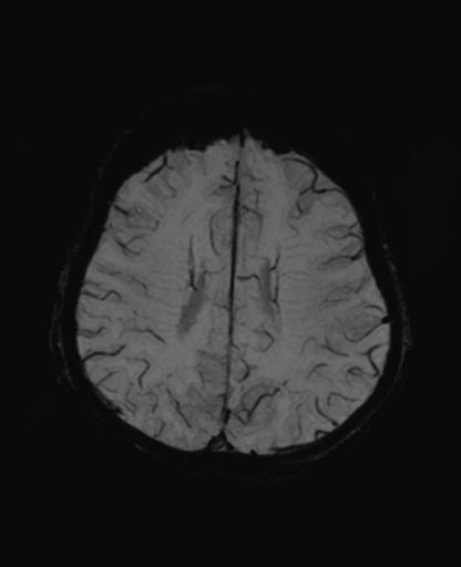 Autoimmune limbic encephalitis (Radiopaedia 30363-31005 SWI - mIP 51).jpg
