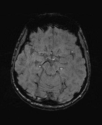Autoimmune limbic encephalitis (Radiopaedia 30363-31005 SWI 30).jpg