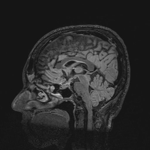 Autoimmune limbic encephalitis (Radiopaedia 30363-31005 Sagittal FLAIR 79).jpg
