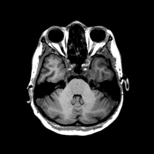 Autoimmune limbic encephalitis (Radiopaedia 30363-31005 T1 Axial 1mm 46).jpg