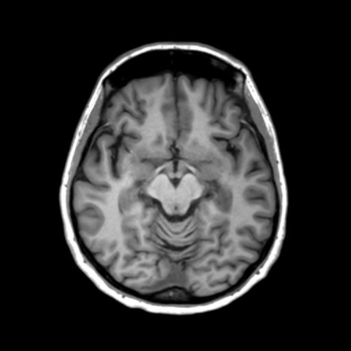 Autoimmune limbic encephalitis (Radiopaedia 30363-31005 T1 Axial 3mm 22).jpg