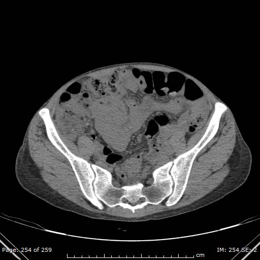 Autosomal dominant polycystic kidney disease (Radiopaedia 44122-47684 Axial non-contrast 91).jpg