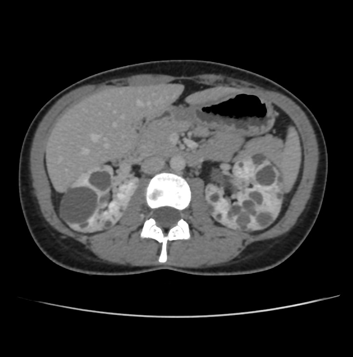 Autosomal dominant polycystic kidney disease - early onset (Radiopaedia 40734-43387 A 28).jpg