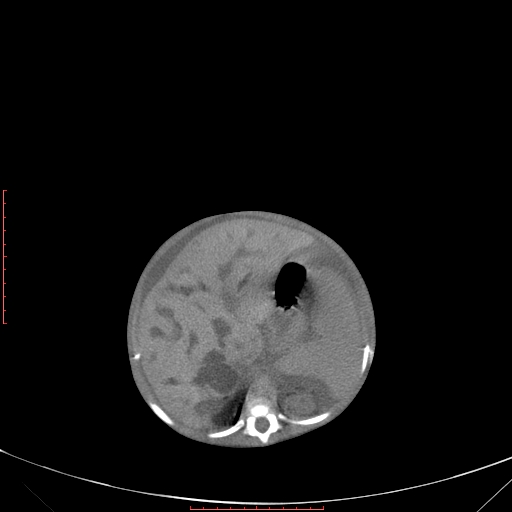 Autosomal recessive polycystic kidney disease associated with Caroli disease (Radiopaedia 61932-69984 Axial non-contrast 139).jpg