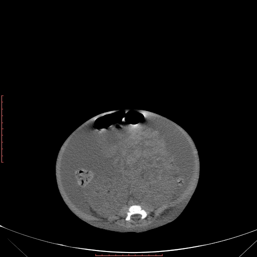 Autosomal recessive polycystic kidney disease associated with Caroli disease (Radiopaedia 61932-69984 Axial non-contrast 253).jpg