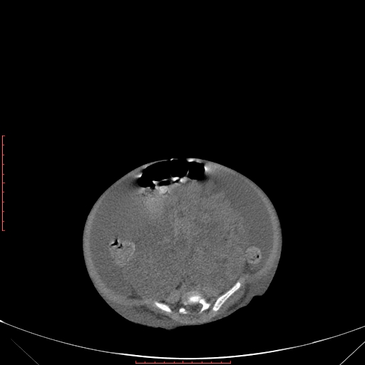 Autosomal recessive polycystic kidney disease associated with Caroli disease (Radiopaedia 61932-69984 Axial non-contrast 268).jpg