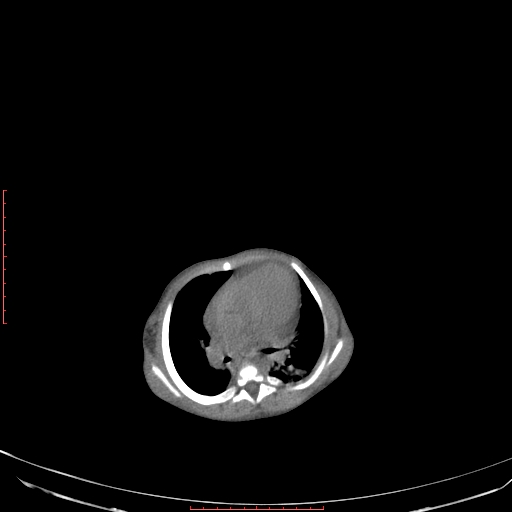 File:Autosomal recessive polycystic kidney disease associated with Caroli disease (Radiopaedia 61932-69984 B 55).jpg