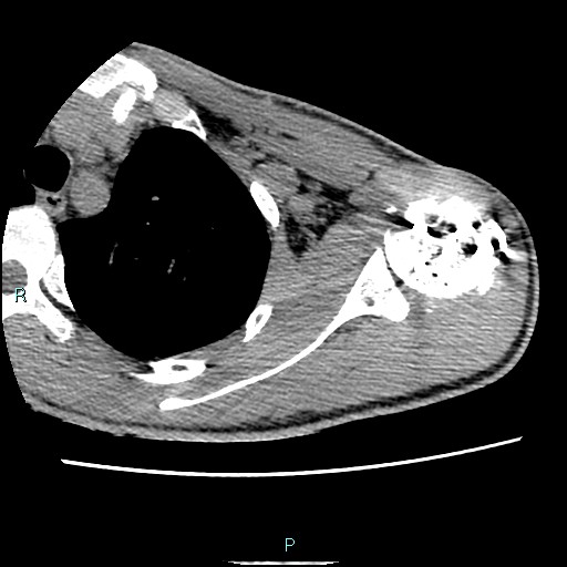 Avascular necrosis after fracture dislocations of the proximal humerus (Radiopaedia 88078-104653 D 39).jpg