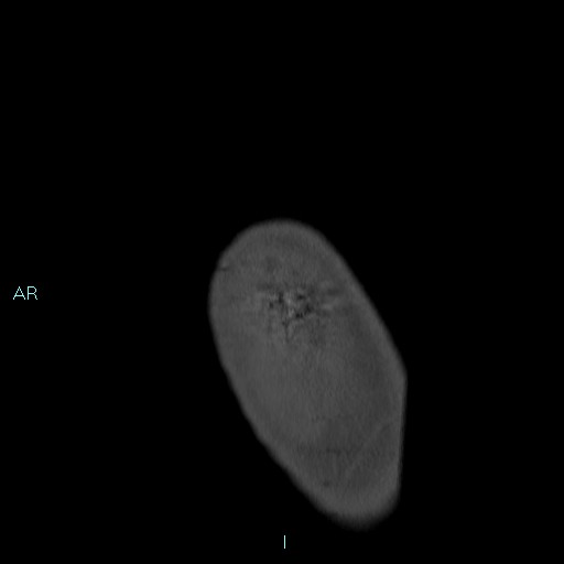 Avascular necrosis after fracture dislocations of the proximal humerus (Radiopaedia 88078-104653 Sagittal bone window 7).jpg