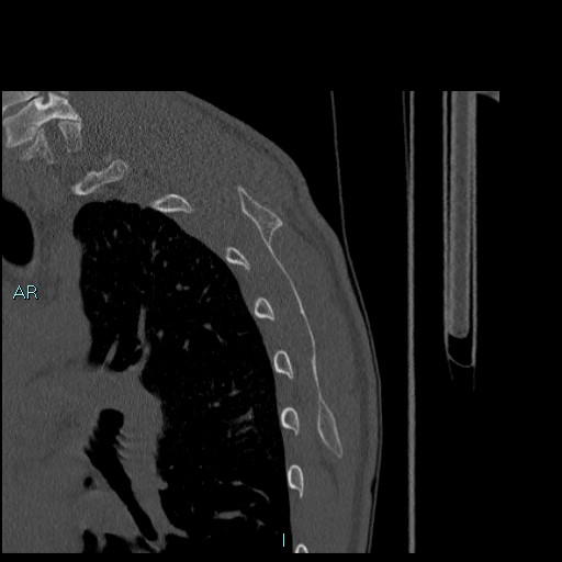Avascular necrosis after fracture dislocations of the proximal humerus (Radiopaedia 88078-104655 Sagittal bone window 78).jpg