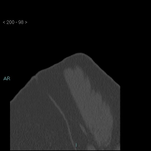 Avascular necrosis of the shoulder - Cruess stage I (Radiopaedia 77674-89887 Sagittal bone window 97).jpg