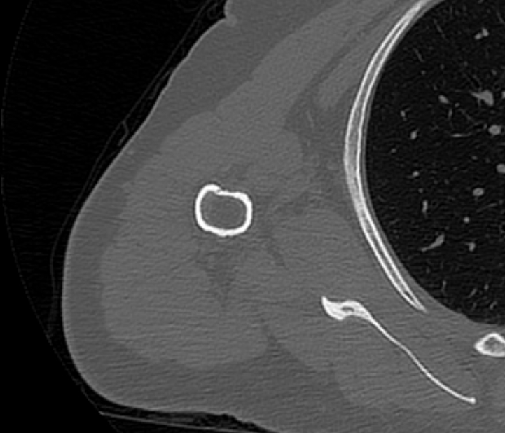 Avulsion fracture - greater tuberosity of humerus (Radiopaedia 71216-81514 Axial bone window 64).jpg