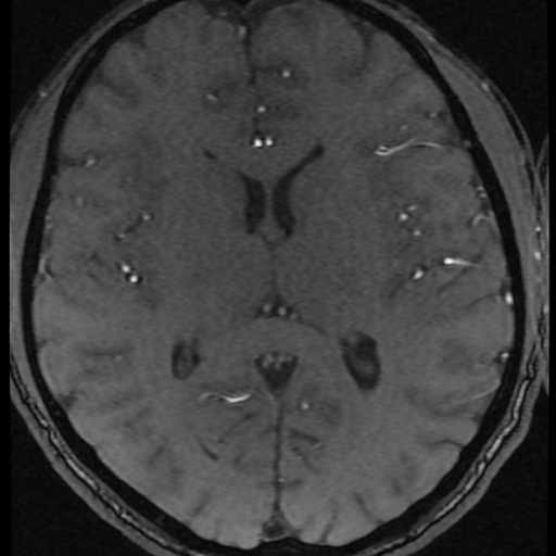 Azygos anterior cerebral artery (Radiopaedia 17059-16756 Axial MRA 5).jpg
