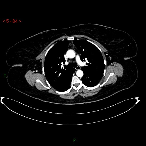 Azygos fissure and lobe (Radiopaedia 47620-52278 A 70).jpg