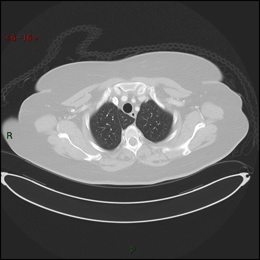 Azygos fissure and lobe (Radiopaedia 47620-52278 Axial lung window 16).jpg