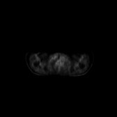 B-cell lymphoma of the mesentery (Radiopaedia 65743-74868 18F-FDG PET-CT 237).jpg