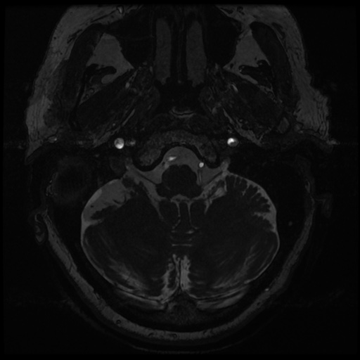 File:Balo concentric sclerosis (Radiopaedia 53875-59982 Axial T2 FIESTA 10).jpg