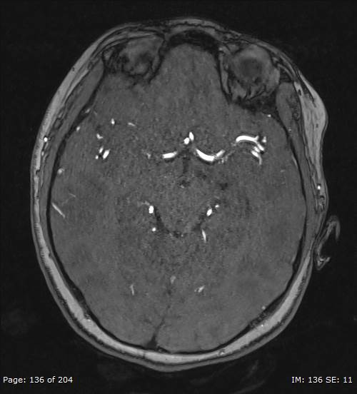 Balo concentric sclerosis (Radiopaedia 61637-69636 Axial MRA 136).jpg