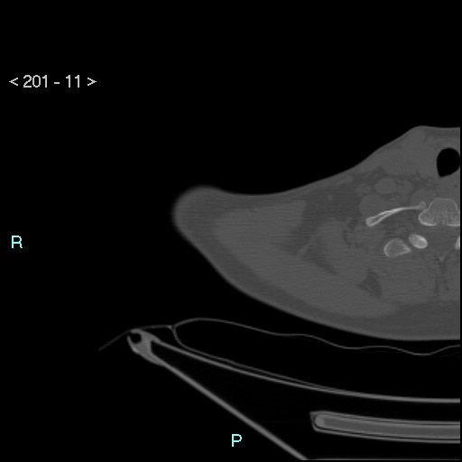 Bankart lesion with glenoid bone defect - assessment TC with PICO method (Radiopaedia 42855-93901 Axial bone window 10).jpg