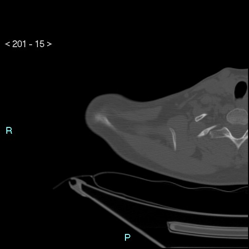 Bankart lesion with glenoid bone defect - assessment TC with PICO method (Radiopaedia 42855-93901 Axial bone window 14).jpg