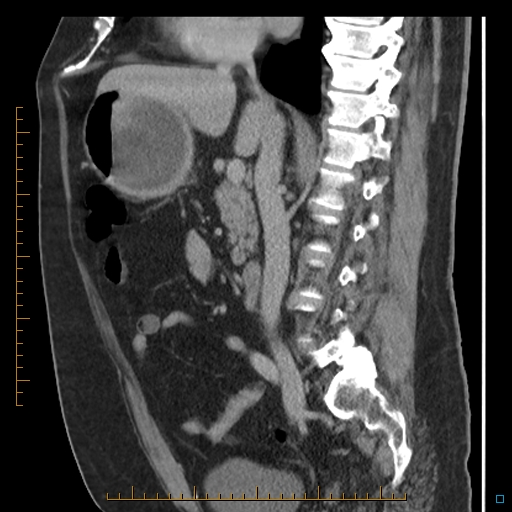 File:Bariatric balloon causing gastric outlet obstruction (Radiopaedia 54449-60672 C 46).jpg