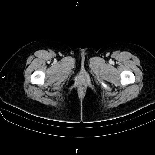 File:Bartholin gland cyst (Radiopaedia 62635-70930 Axial Post contrast 99).jpg