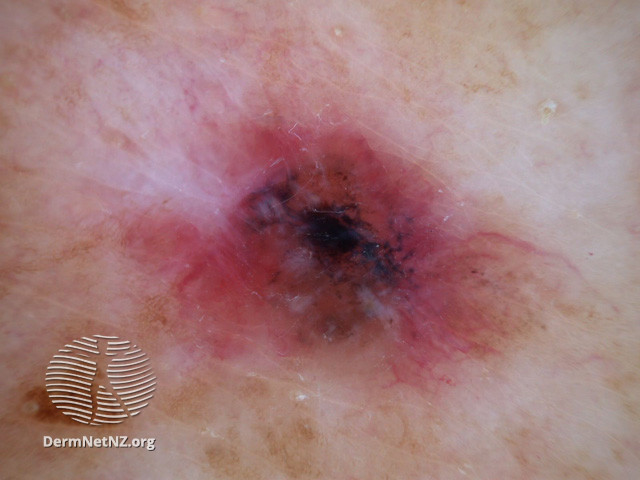File:Basal cell carcinoma affecting the face (DermNet NZ lesions-bcc-face-1082).jpg