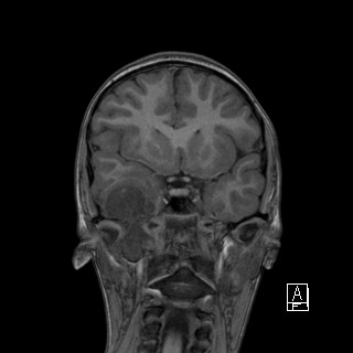 Base of skull rhabdomyosarcoma (Radiopaedia 32196-33142 Coronal T1 17).jpg