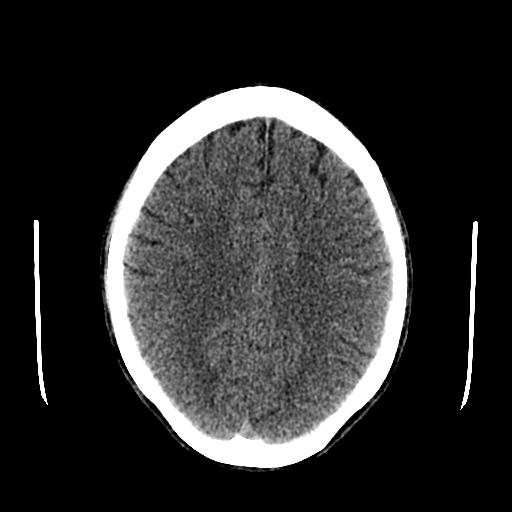 File:Basilar artery perforator aneurysm (Radiopaedia 82455-96597 Axial non-contrast 24).jpg