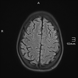 File:Basilar artery perforator aneurysm (Radiopaedia 82455-99523 Axial FLAIR 18).jpg