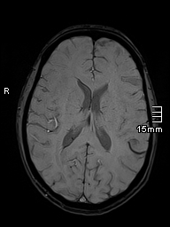 Basilar artery perforator aneurysm (Radiopaedia 82455-99523 Axial SWI 39).jpg