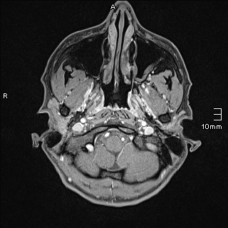 Basilar artery perforator aneurysm (Radiopaedia 82455-99523 G 1).jpg