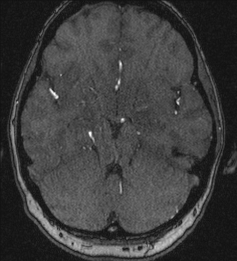 Basilar tip aneurysm (Radiopaedia 26504-26632 MRA 84).jpg