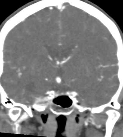 Basilar tip aneurysm with coiling (Radiopaedia 53912-60086 B 72).jpg