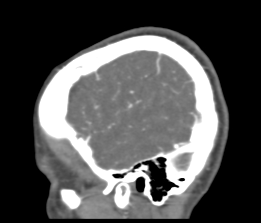 Basilar tip aneurysm with coiling (Radiopaedia 53912-60086 C 118).jpg