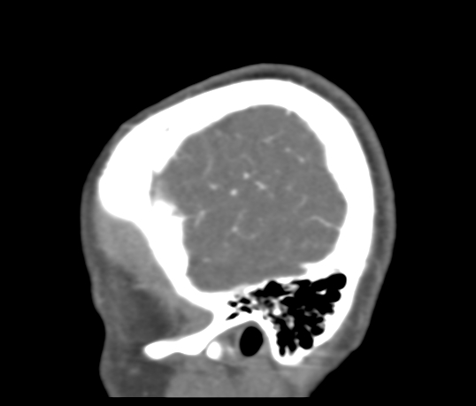 Basilar tip aneurysm with coiling (Radiopaedia 53912-60086 C 124).jpg